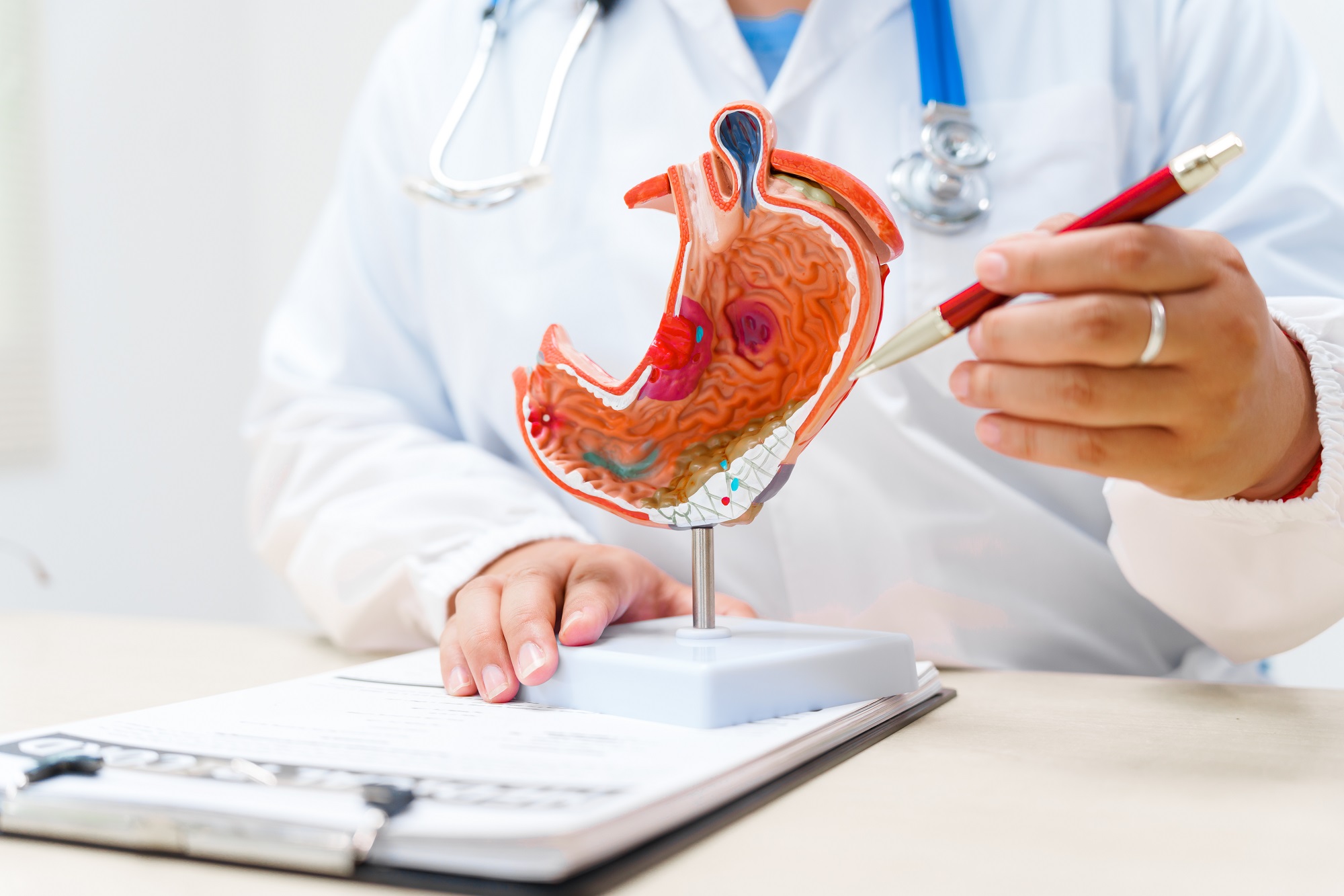 acid reflux treatment
